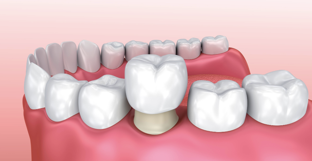 Dental Crowns Albany