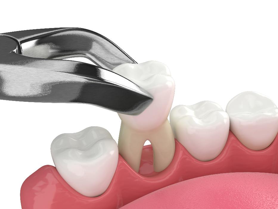 Tooth Extractions