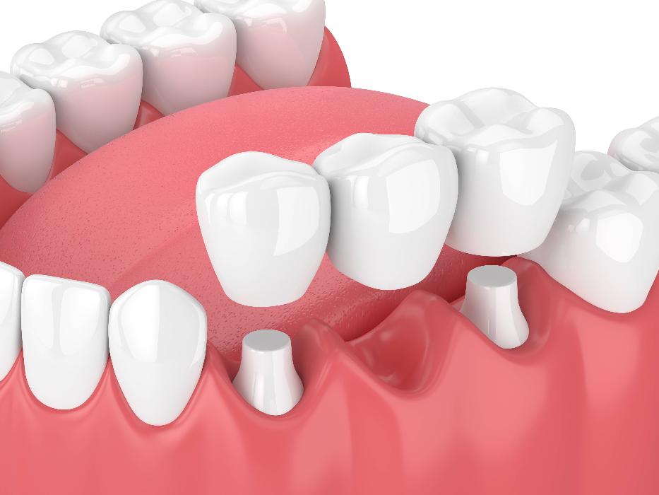 Dental Dentures Albany 