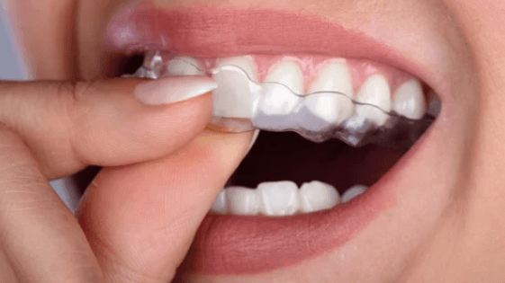Dental Braces
