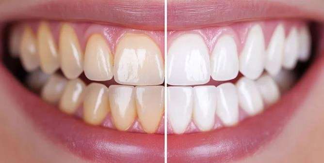 Bright Teeth Whitening