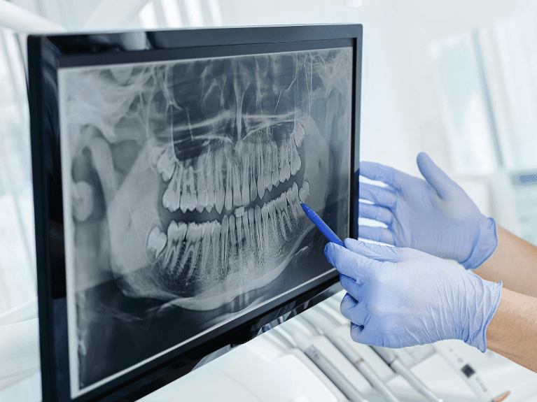 Digital X-Rays Albany Dental